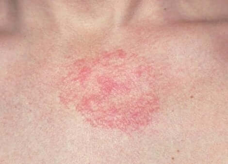 Une irritation cutanée. 
