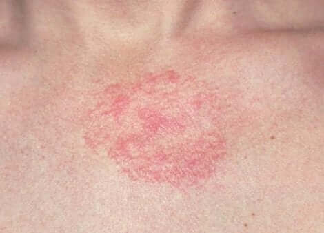 Une dermatite sur la peau.