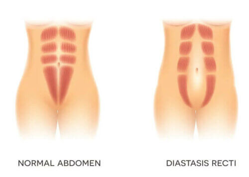 La diastase abdominale.