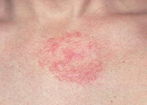 Eruption cutanée actinodermatose.