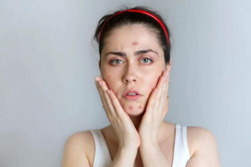 alimentation et l'acné sont elle vraiment liées ?
