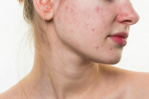 L acné kystique chez une femme.