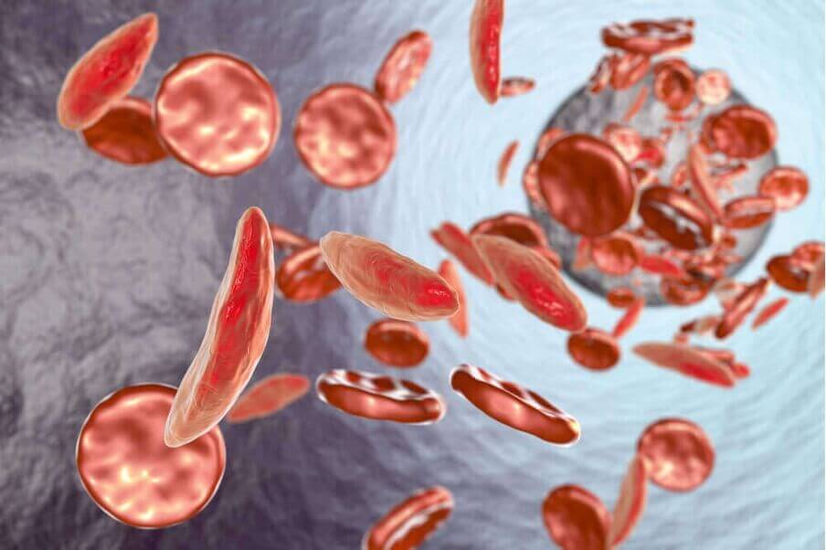 L'anémie de Fanconi est une maladie héréditaire dont la principale caractéristique est l'incapacité à produire une quantité suffisante de nouvelles cellules sanguines.