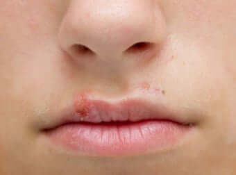 Bouton d'herpès sur le bord de la lèvre supérieure. 