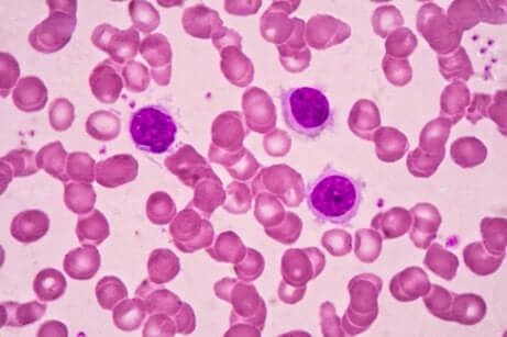 Le lymphome au microscope.