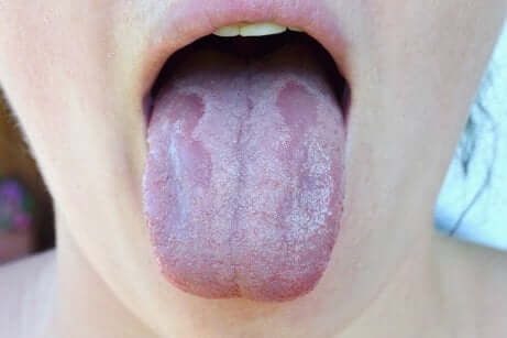 Les maladies de la langue.
