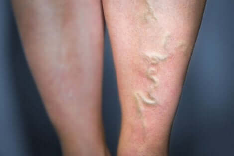 Des varices dans les jambes.