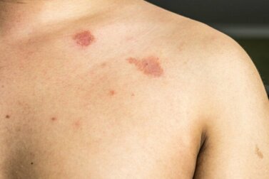 Pityriasis versicolore : qu'est-ce que c'est ?