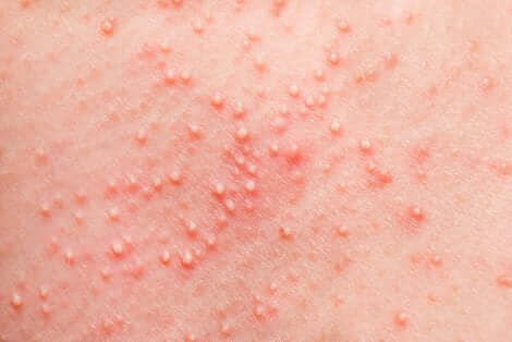 Une réaction allergique sur la peau.