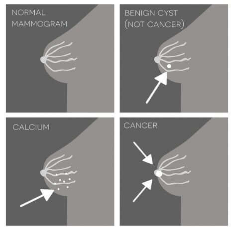 Schéma de calcifications mammaires bénignes ou malignes.