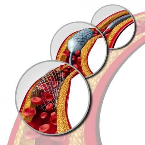Un stent pour une athérosclérose.
