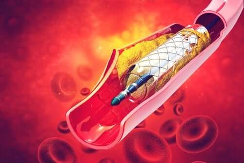 Qu'est-ce qu'un stent et à quoi sert-il ?