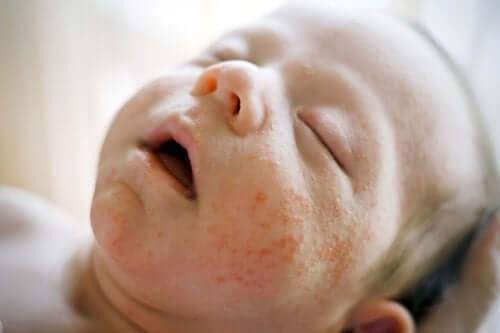 Sudamina ou miliaire : en quoi consiste-t-elle ?