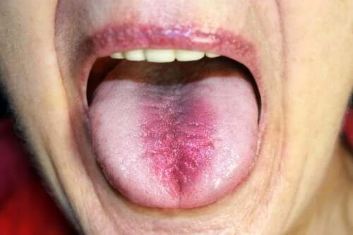Syndrome de la bouche brûlante