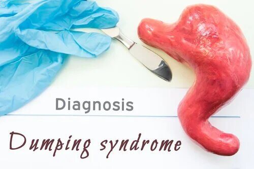 Qu'est-ce que le syndrome de dumping ?