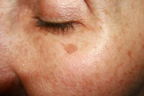 Des taches sur le visage.