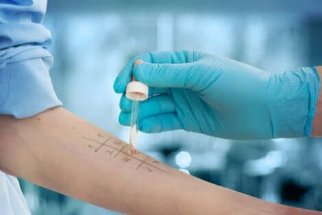 Test cutané de diagnostic d'allergie.