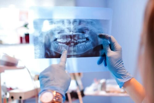 Etude avant de poser une prothèse sur implants dentaires
