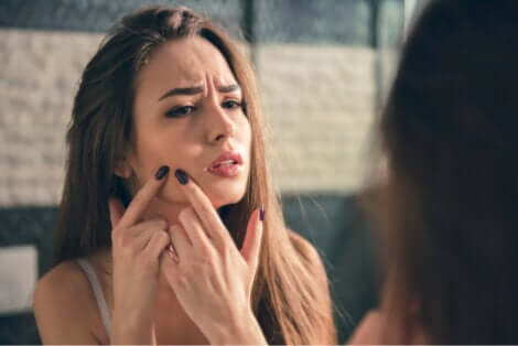 Acné chez une femme.