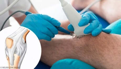 Arthroscopie du genou.