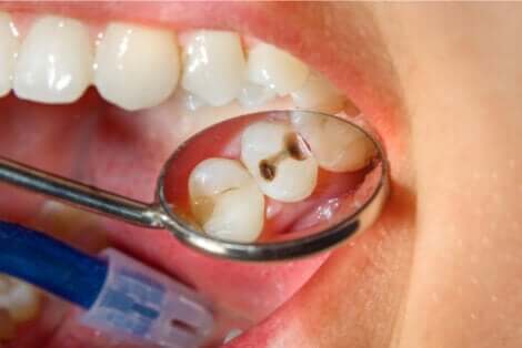 Des caries dentaires.