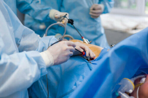 Une stomie sur un patient.