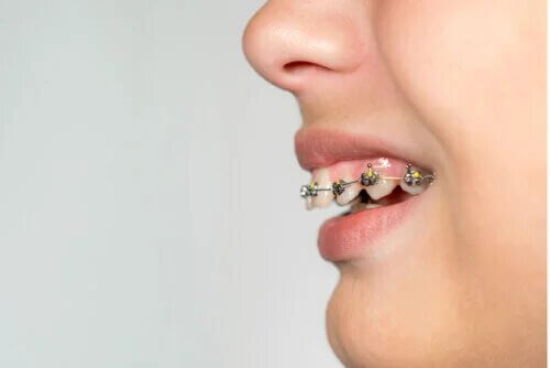 Qu'est-ce qu'une supraclusion et comment est-elle traitée ?