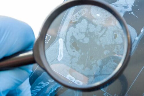 Qu'est-ce qu'une fistule gastro-intestinale et qu'est-ce qui la cause ?