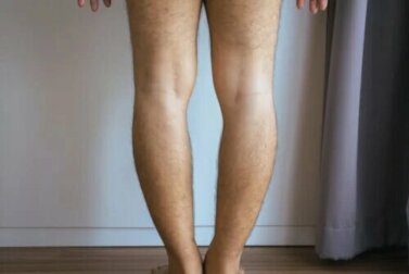 Genu varum ou jambes arquées : pourquoi se produit-elle et comment est-elle traitée ?
