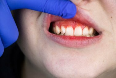 Bouche des tranchées : origine, symptômes et traitement