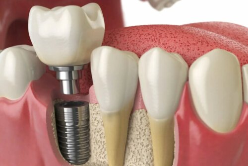 Prothèse sur implants dentaires mise en place