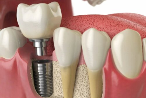 Prothèse sur implants dentaires mise en place