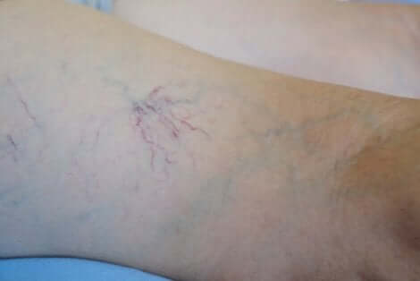 Insuffisance veineuse chez une femme.