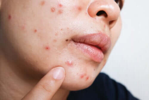 Isotrétinoïne pour l'acné : bienfaits et effets secondaires
