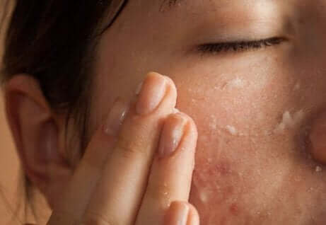 Une femme souffrant d'acné se mettant de la crème.
