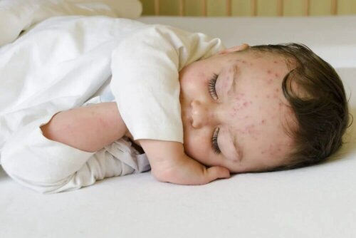 Un bébé avec la varicelle.