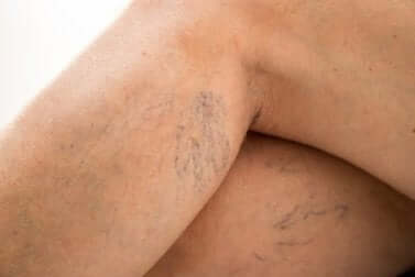 Une femme qui a des varices.