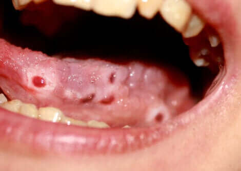 Une femme souffrant de candidose.