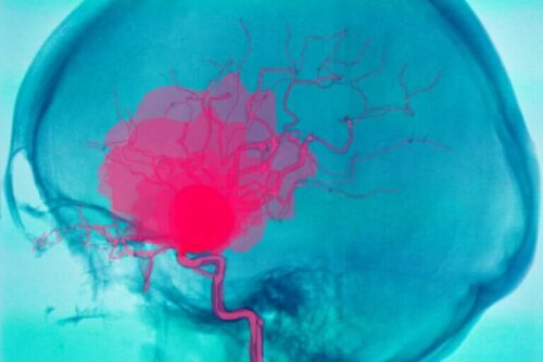 Qu'est-ce qu'une hémorragie cérébrale et pourquoi peut-elle se produire ?