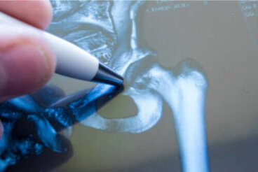 Fracture de la hanche : tout ce qu'il faut savoir
