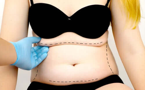 Qu'est-ce que l'abdominoplastie ?