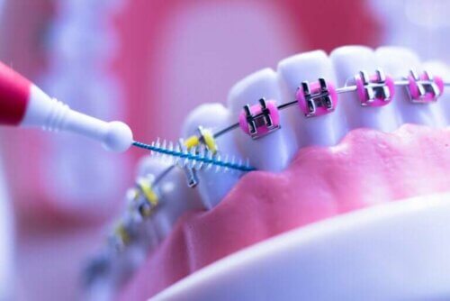 8 soins que toute personne avec un appareil dentaire doit suivre
