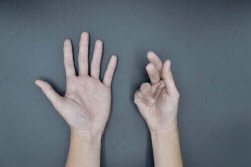 Contracture de Dupuytren : cause, symptômes et traitements