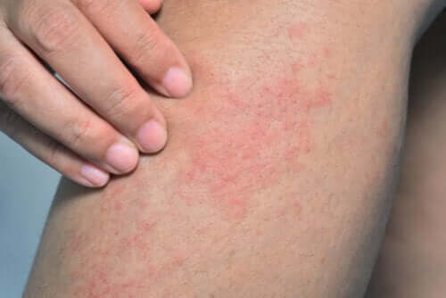 Dermatite du nageur : causes, symptômes et traitement