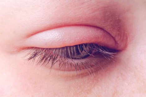 Une inflammation de la paupière.
