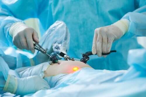 Qu'est-ce qu'une laparoscopie ?