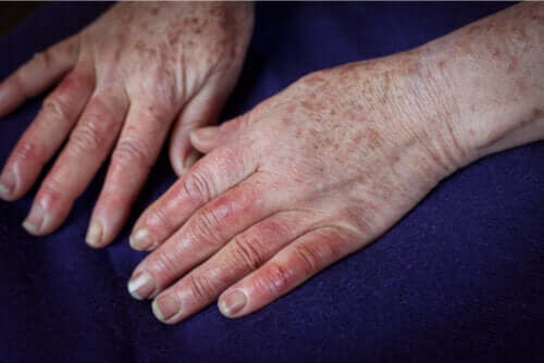 Maladie de Buerger : causes, symptômes et traitements