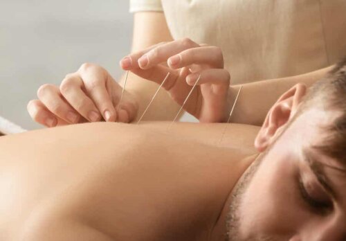 Pose d'aiguilles d'acupuncture.