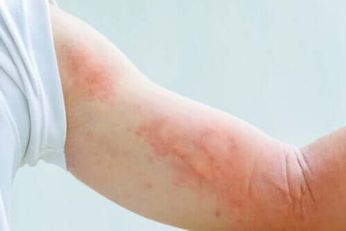 Eczéma et stress : quel est leur lien ?