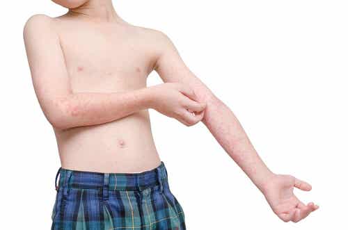 Un enfant souffrant de peau atopique.